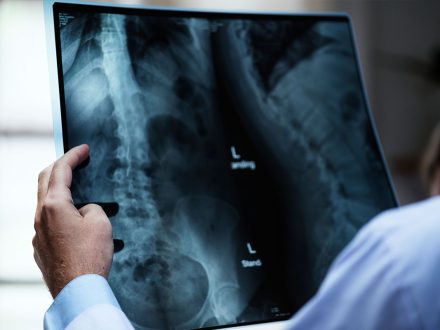 Endoskopik Omurga, Endoskopik Omurga Cerrahisi, Endoskopik omurga ameliyatı, Endoskopik bel fıtığı ameliyatı, Endoskopik boyun fıtığı ameliyatı, Endoskopik kanal daralması ameliyatı, Minimal invaziv omurga cerrahisi, Omurga cerrahisi yöntemleri, Omurga ameliyatı endoskopik teknik, Bel fıtığı endoskopik tedavi, Boyun fıtığı endoskopik tedavi, Spinal endoskopik cerrahi, Endoskopik omurga cerrahisi uzmanı, Endoskopik omurga cerrahisi doktoru, En İyi Endoskopik omurga cerrahisi uzmanı, En İyi Endoskopik omurga cerrahisi doktoru, En İyi Endoskopik cerrahi Doktoru, En İyi Endoskopik cerrahi Uzmanı